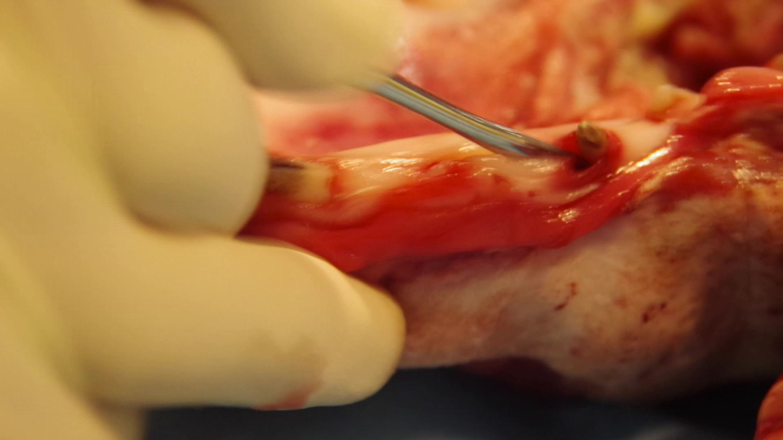 INCISION CRESTALE